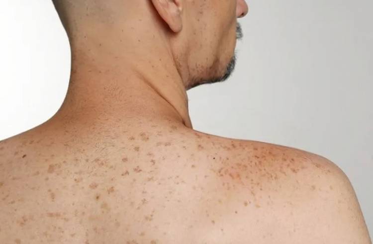 LALCEC realiza una campaña contra el “Cáncer de Piel”